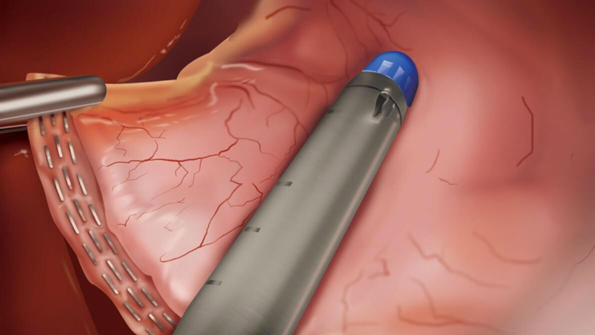  Entenda tudo sobre a cirurgia Bypass